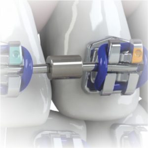 סטופרים פתוחים