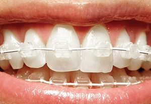 חוט אורטו לבן